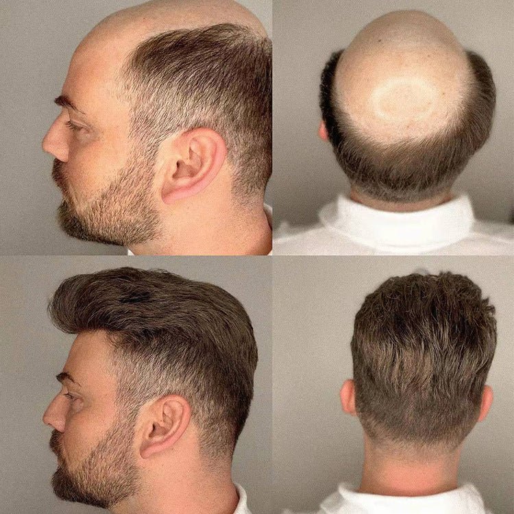Ultra-Thin Skin V-Loop Hair System  - Invisible Bio-Scalp Realism